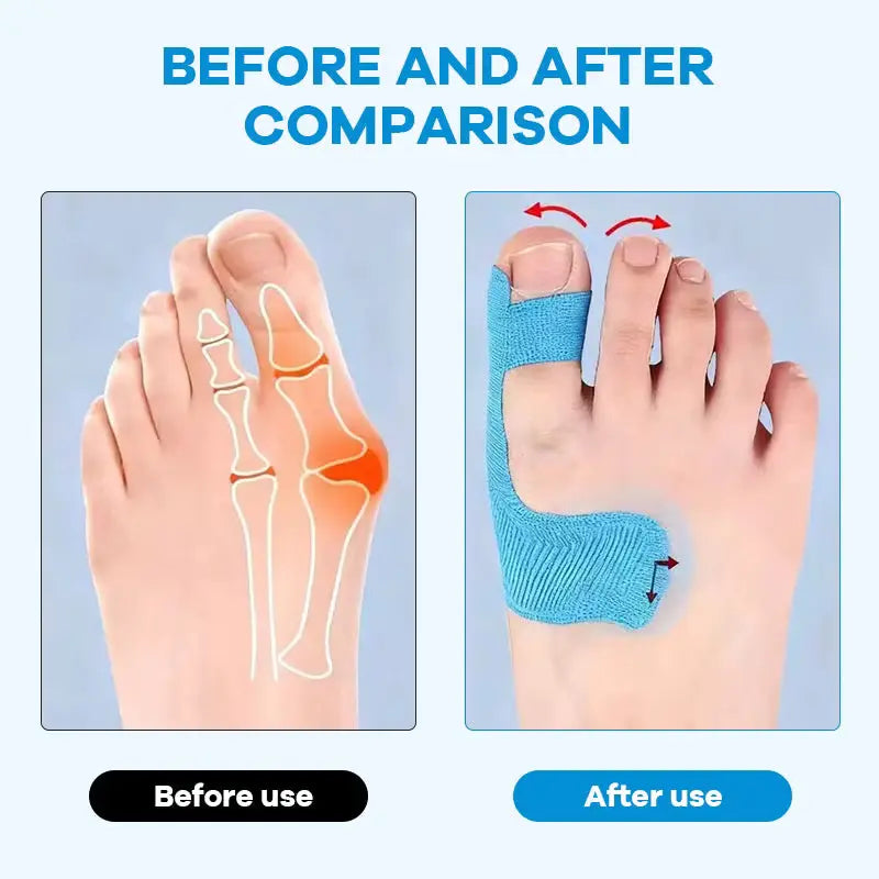 Pre-Cut Bunion Corrector Tape – Waterproof Toe Support Strips